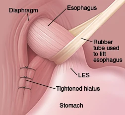 Lifting the Esophagus