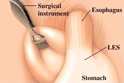 Stomach being wrapped around the esophagus. This added support helps prevent reflux.