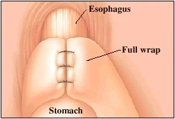 The wrap is permanently stitched in place. Two commonly used wraps are full and partial.