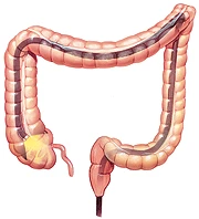 Colonoscopy provides an inside view of the entire colon.