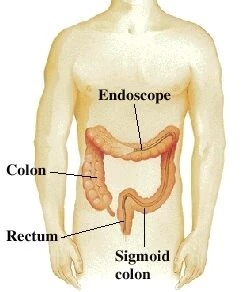 During endoscopy, a long, flexible tube is used to view the inside of your lower GI tract.