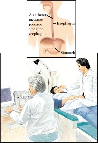 Esophageal Manometry