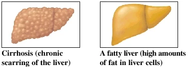 Cirrhosis and a fatty liver