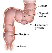 Colorectal Cancer Screening