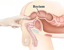 A DRE can detect a growth in the rectum or anus.