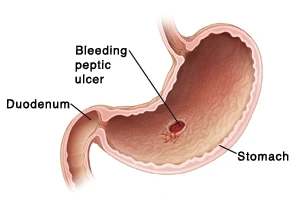 A bleeding peptic ulcer is a serious problem and must be treated right away.