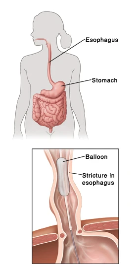 A balloon dilator may be used to widen a stricture in the esophagus.