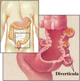 Diverticula