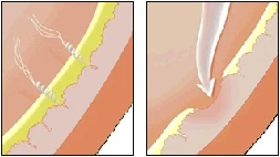 H. pylori invade and disturb the lining of digestive tract. Acid may weaken the area, causing an ulcer.