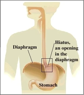 Illustration of the stomach, diaphragm, and hiatus