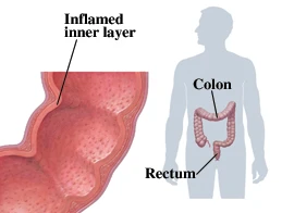 Ulcerative Colitis