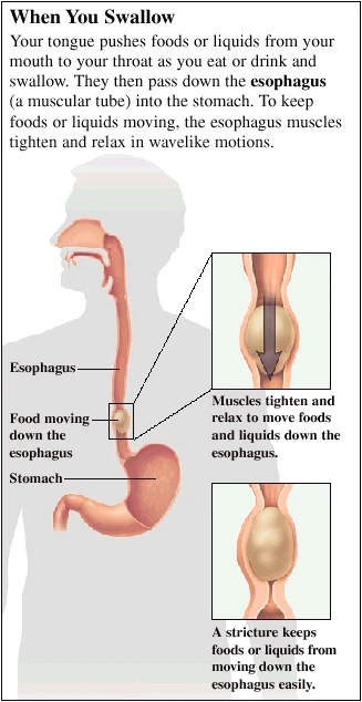 Understanding Dysphagia