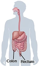 Colon And Rectal Cancer (Colorectal Cancer)