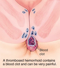 Thrombosed Hemorrhoids