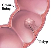 Colon with a polyp