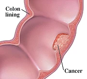 Colon cancer