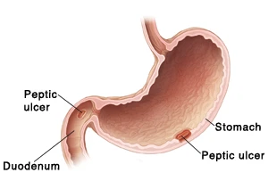 Peptic Ulcer