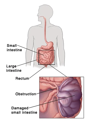 Small Bowel Obstruction