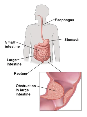 Large Bowel Obstruction