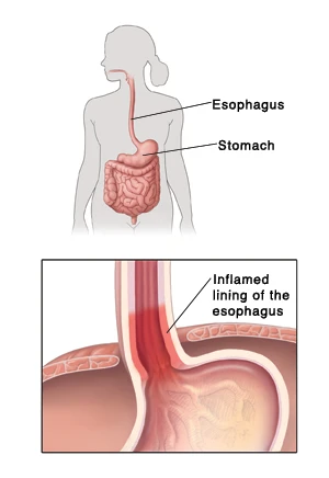 With esophagitis, the lining of the esophagus is inflamed.