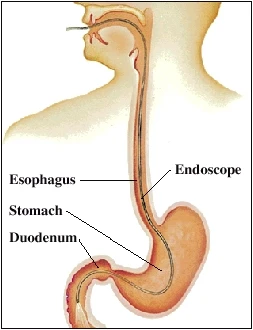 Upper GI Endoscopy