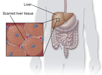 Hepatitis C And HCV Infection