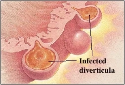 Infected diverticula