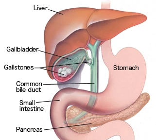 What Are Gallstones?